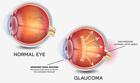 GLAUCOMA CARE